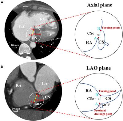 Association Between the Coronary Sinus Ostial Size and Atrioventricular Nodal Reentrant Tachycardia in Patients With Pulmonary Arterial Hypertension